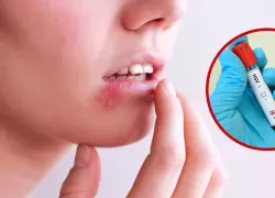 Un virus que no se cura: ¿Cómo se transmite el  herpes simple?