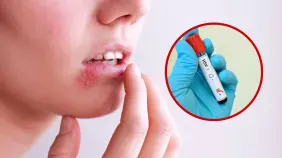 Un virus que no se cura: ¿Cómo se transmite el  herpes simple?