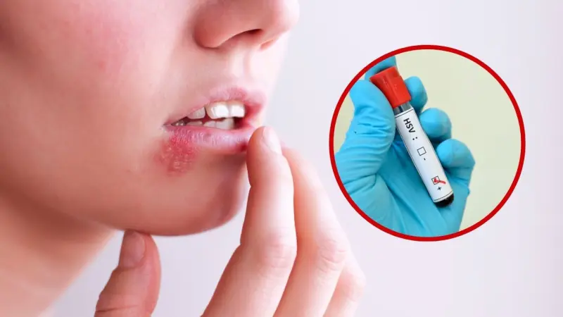 Un virus que no se cura: ¿Cómo se transmite el  herpes simple?