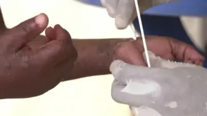 Un año después de la alerta sanitaria, la epidemia de mpox sigue preocupando en África