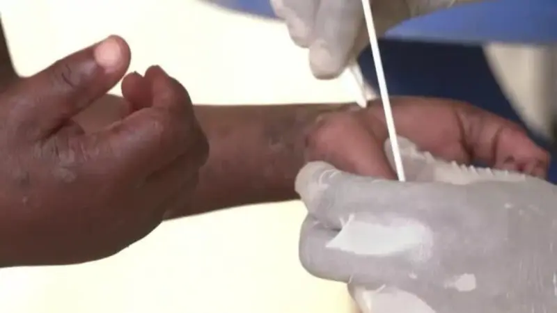 Un año después de la alerta sanitaria, la epidemia de mpox sigue preocupando en África