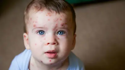 S&iacute;ndrome de pie, boca, mano y varicela &iquest;Qu&eacute; hacer ante lesiones en la piel de los ni&ntilde;os?