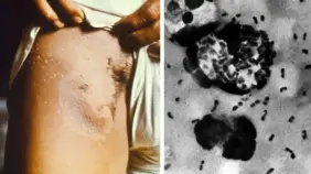 Detectan caso de peste bubónica en residente de California, EEUU