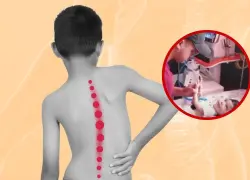 Padres luchan contra reloj para salvar a su hijo con atrofia muscular