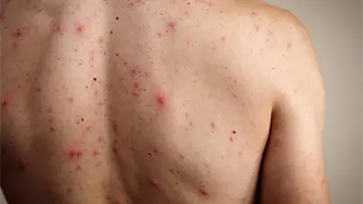 Autoridades de EE.UU. informan de un cuarto caso de sarampi&oacute;n en Virginia en 2025