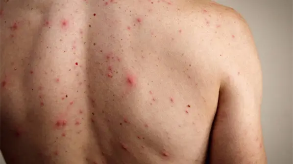 Un brote de sarampión por falta de vacunación deja ya nueve niños muertos en Israel