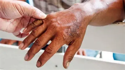 Septiembre es el Mes de la Lepra: Una oportunidad para educar, sensibilizar y sanar