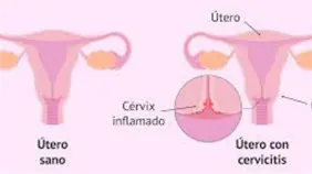 Cervicitis en mujeres: factores y cuidados por Dra. Lilian Fondeur