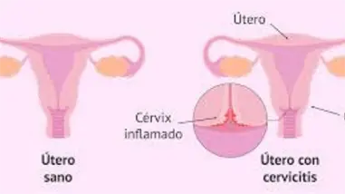 Cervicitis en mujeres: factores y cuidados por Dra. Lilian Fondeur