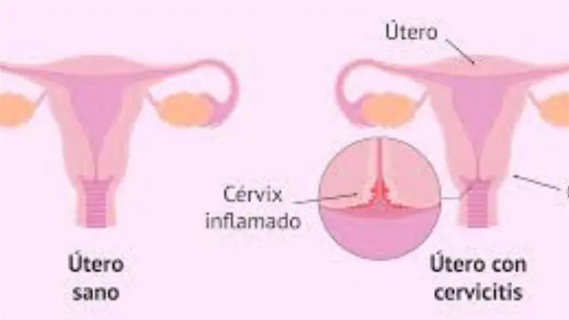 Cervicitis en mujeres: factores y cuidados por Dra. Lilian Fondeur