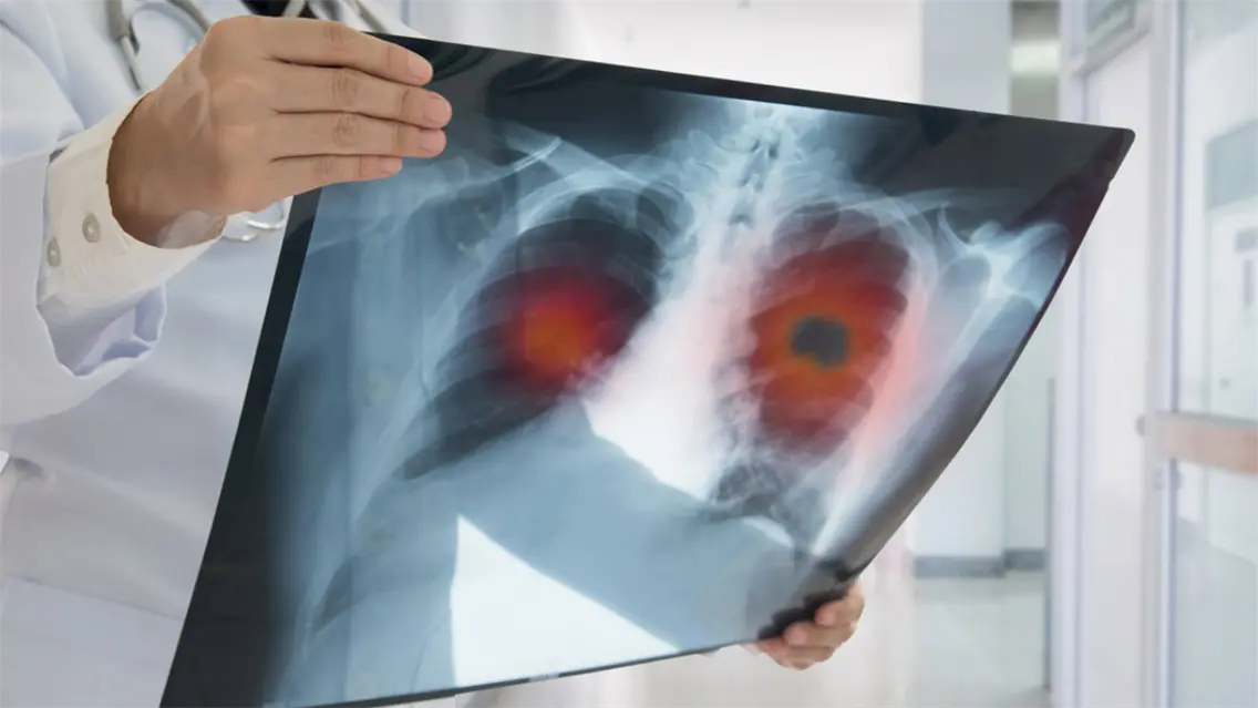 Supervivencia a cáncer de pulmón sube de 23 al 60 % con diagnóstico temprano, dice experta