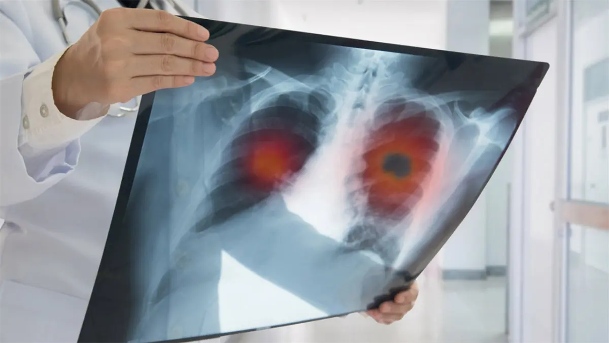 Supervivencia a cáncer de pulmón sube de 23 al 60 % con diagnóstico temprano, dice experta