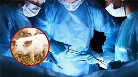 Una persona logra vivir casi seis meses con un hígado de cerdo trasplantado