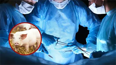 Una persona logra vivir casi seis meses con un hígado de cerdo trasplantado