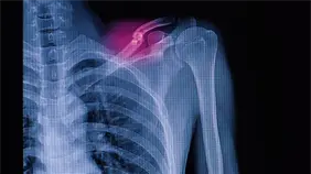 Hong Kong desarrolla nanocemento óseo para tratamiento de fracturas y reparación rápida