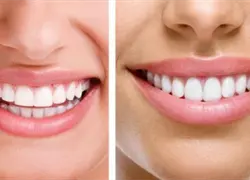 Revelan una inquietante relación entre tu sonrisa y el riesgo de muerte prematura