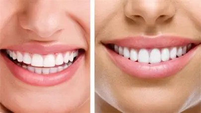 Revelan una inquietante relación entre tu sonrisa y el riesgo de muerte prematura