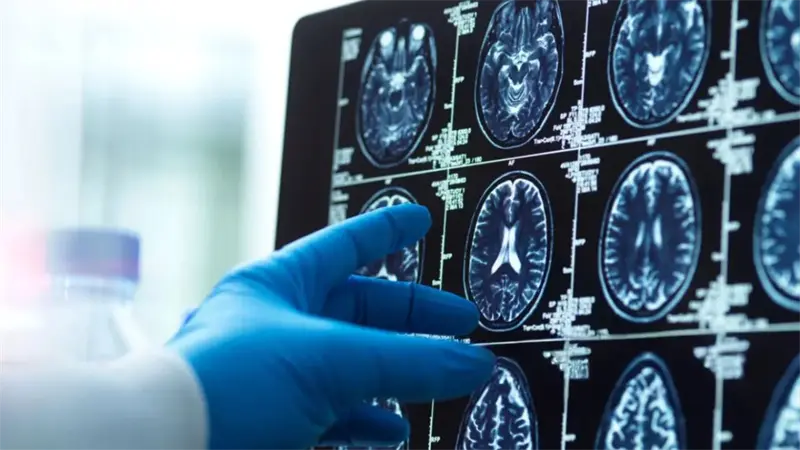 Descubren nueva enfermedad neurológica ultrarrara con solo 13 casos en el mundo