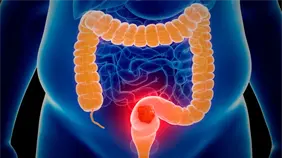 El cáncer colorrectal se protege de la inmunoterapia con un doble escudo, según un estudio El cáncer colorrectal se protege de la inmunoterapia con un doble escudo, según un estudio