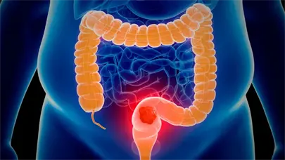 El c&aacute;ncer colorrectal se protege de la inmunoterapia con un doble escudo, seg&uacute;n un estudio