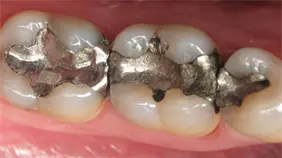 Estados acuerdan poner fin a las amalgamas dentales con mercurio en 2034