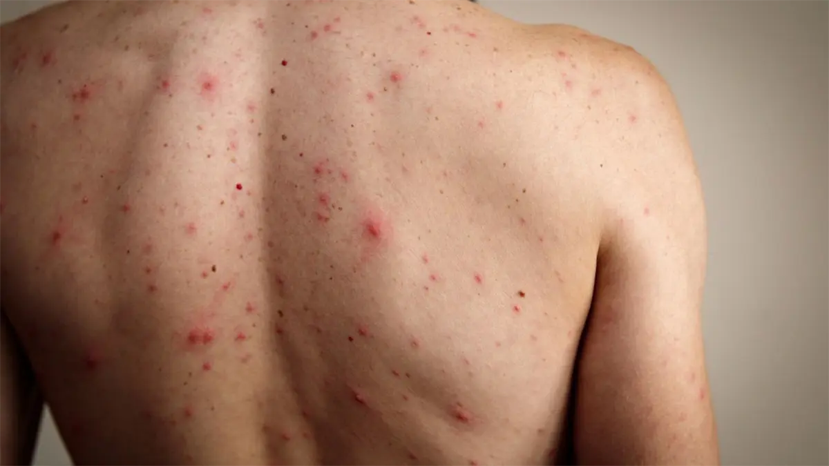 Uruguay confirma tres casos de sarampión y refuerza medidas preventivas