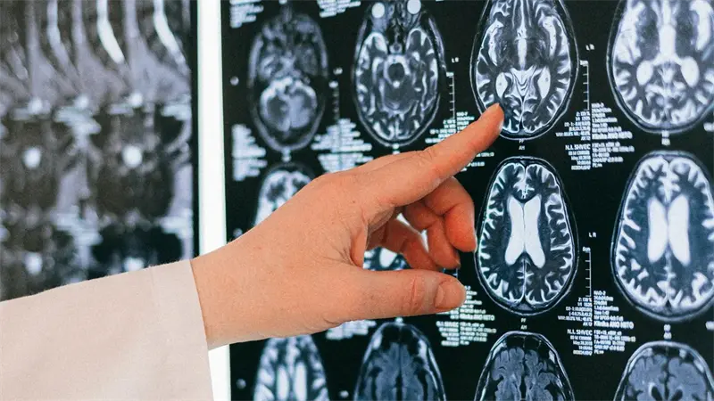 Crean células capaces de eliminar el glioblastoma, uno de los peores tumores cerebrales