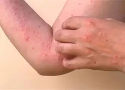 Activan alerta en sectores vulnerables del Gran Santo Domingo tras casos importados de Chikungunya