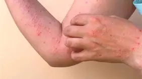 ¿Qué es la chikungunya, cómo se transmite y cuáles son sus síntomas?