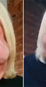 El procedimiento clandestino que desfiguró la cara de una influencer brasileña El procedimiento clandestino que desfiguró la cara de una influencer brasileña