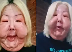 El procedimiento clandestino que desfiguró la cara de una influencer brasileña