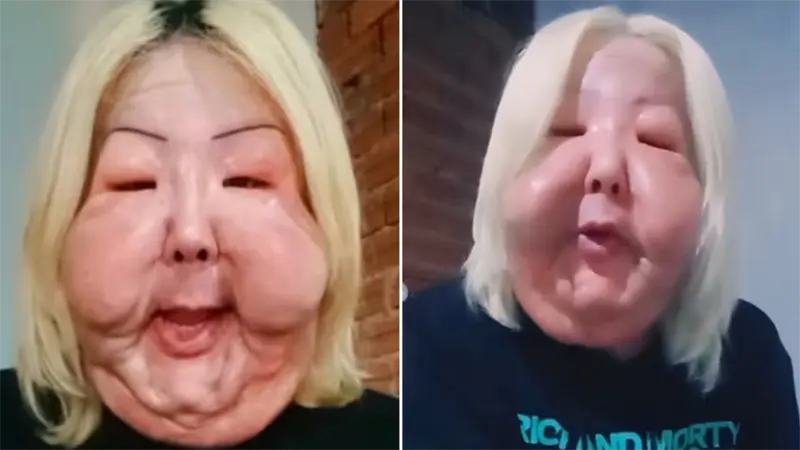 El procedimiento clandestino que desfiguró la cara de una influencer brasileña