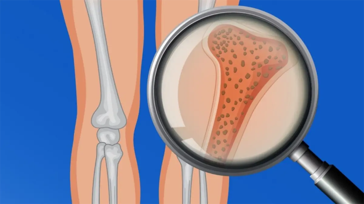 Como si me comiera desde dentro: la enfermedad que ataca los huesos