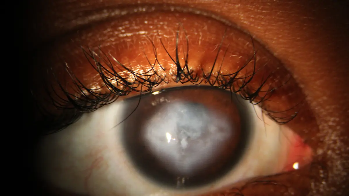 200 mil dominicanos podrían tener queratocono en República Dominicana