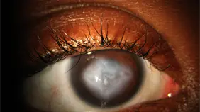 Más de 200 mil dominicanos podrían tener queratocono