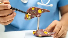 Una dieta rica en grasas aumenta la probabilidad de c&aacute;ncer de h&iacute;gado