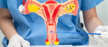 &iquest;Qu&eacute; es la miomectom&iacute;a laparosc&oacute;pica y cu&aacute;les son sus beneficios?