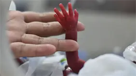 Demuestran los beneficios de transfundir sangre de cord&oacute;n umbilical a prematuros extremos