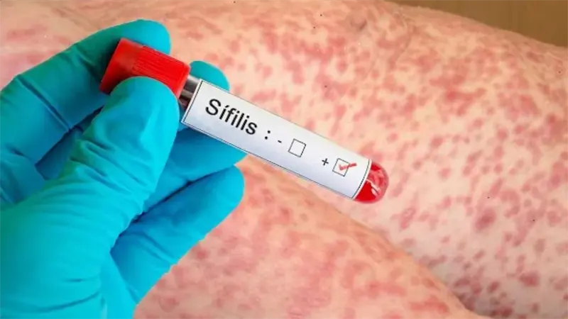 La s&iacute;filis circulaba por Am&eacute;rica hace 5, 500 a&ntilde;os, seg&uacute;n un estudio