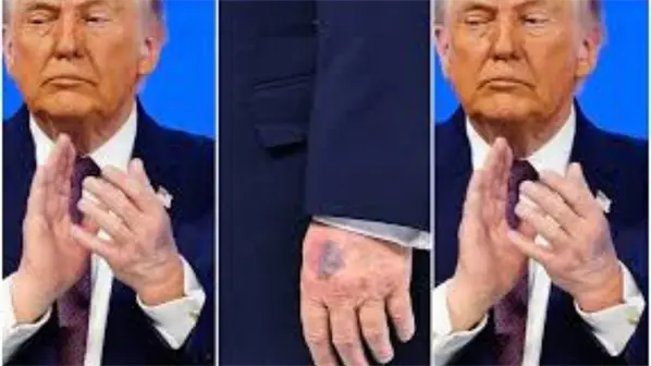 Trump atribuye un nuevo moret&oacute;n en su mano izquierda a un golpe contra una mesa