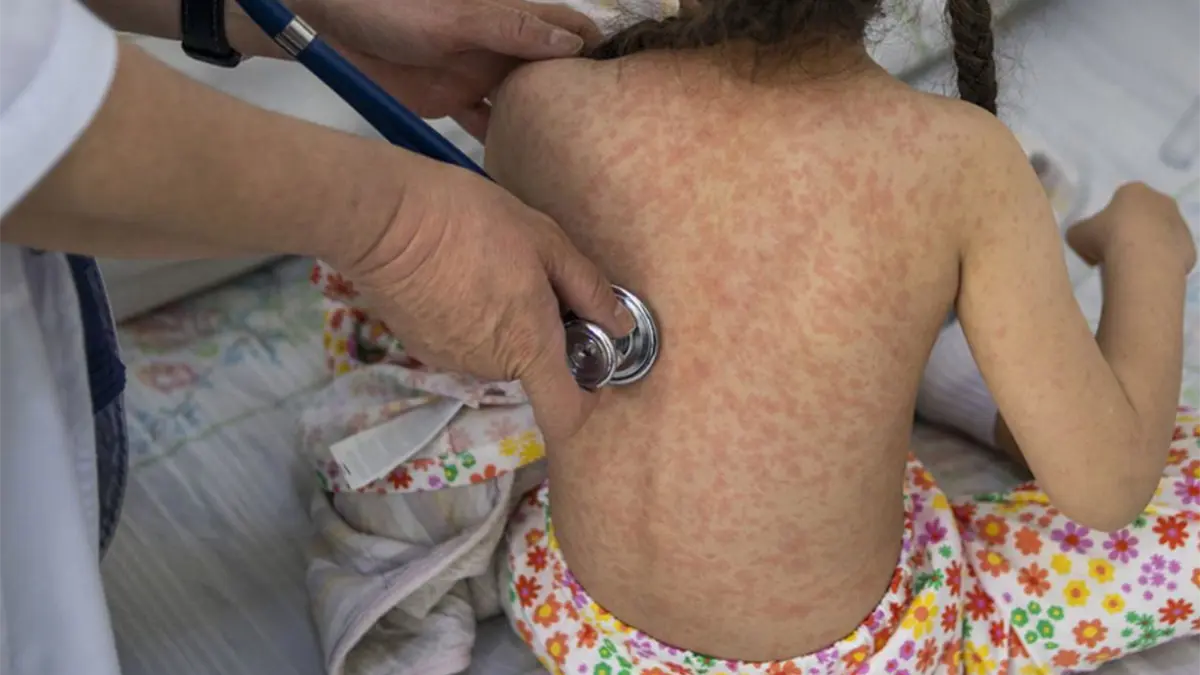 Sarampión transmisión endémica España.