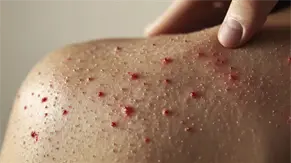 Florida alerta de brotes de sarampi&oacute;n en universidades ante r&eacute;cord del virus en EE.UU.