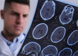 D&iacute;a Internacional de la Epilepsia: Control de casos resistentes al tratamiento