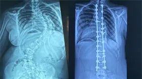 Hospital Reid Cabral y Rehabilitaci&oacute;n superan 350 cirug&iacute;as de escoliosis pedi&aacute;trica