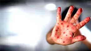 M&eacute;xico eleva a 33 las muertes por brote de sarampi&oacute;n al confirmar dos nuevos decesos