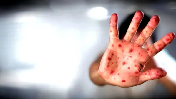 M&eacute;xico eleva a 33 las muertes por brote de sarampi&oacute;n al confirmar dos nuevos decesos