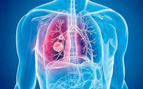 ¿Qué es la fibrosis pulmonar? la enfermedad que mató a Yoskar Sarante