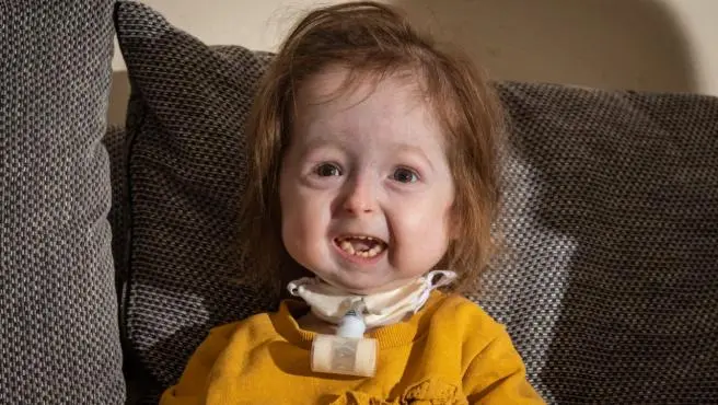 Niña con la enfermedad de Benjamin Button tiene una mutación nunca antes vista