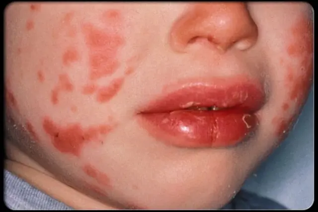 COVID-19 podría estar relacionado con la enfermedad rara infantil Kawasaki