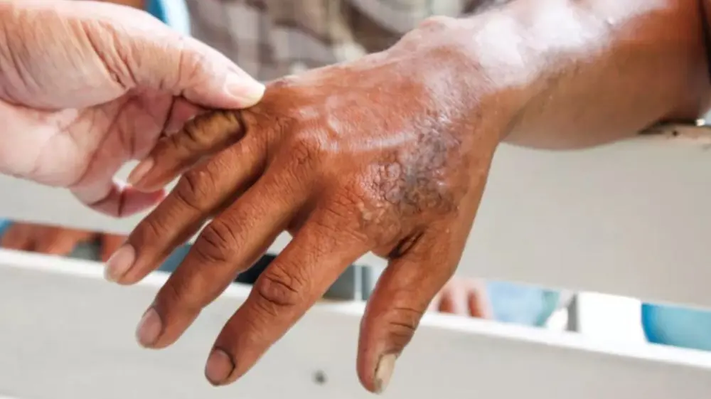 ¿Cómo se contagia la Lepra?